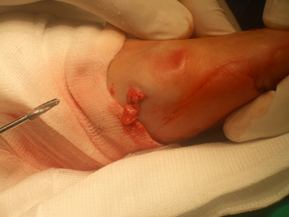 Cirugia percut�nia o de m�nia incisi�